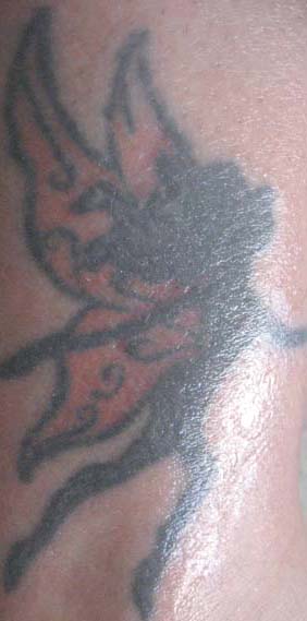 Tags: fade, gross, hurt, nuviderm, remove, tattoo, tca, tough, white, worse