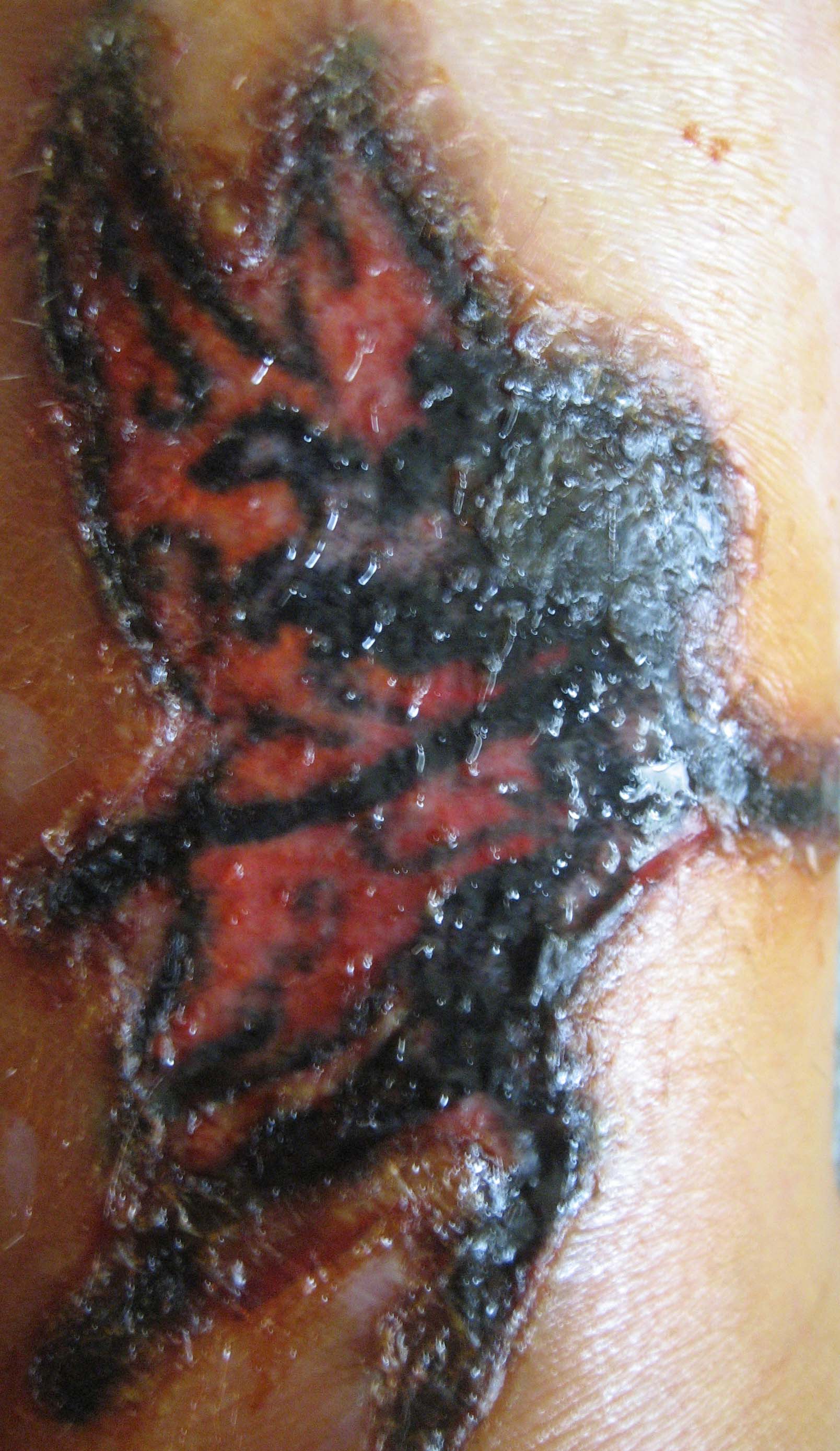 infected scab pictures
