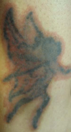 Nuviderm At Home Tattoo Removal Day One Third Application March 29 2009