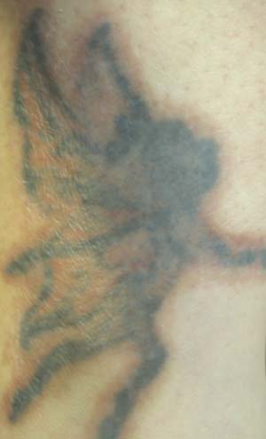 Nuviderm At Home Tattoo Removal Day Two Third Application March 30 2009