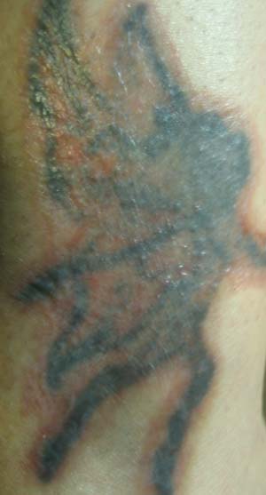 Nuviderm At Home Tattoo Removal Day Two Third Application March 30 2009