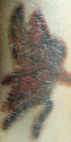 Nuviderm At Home Tattoo Removal:Week One (Third Application) April 7, 2009
