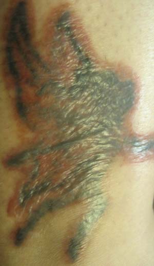 Now, there are two main methods of tattoo removal, the first using a