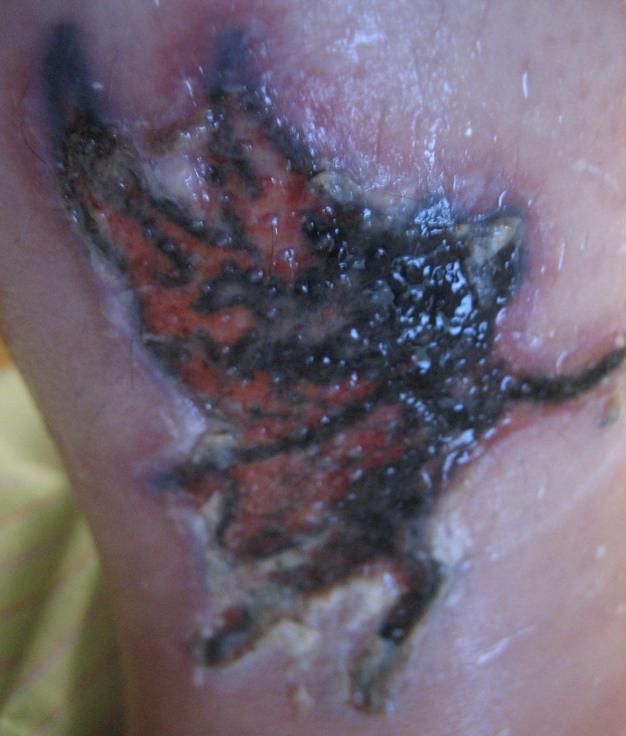 Nuviderm At Home Tattoo Removal: Week Three (Second Application ...